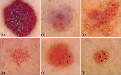 Dermoscopic Features Summarization and Comparison of Four Types of Cutaneous Vascular Anomalies